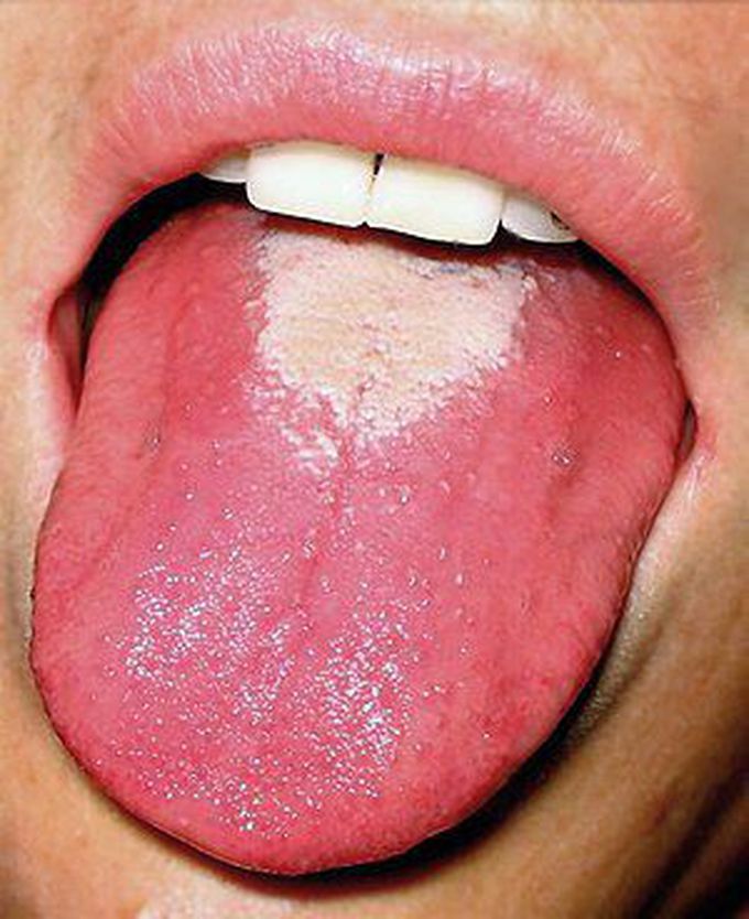 Strawberry tongue seen in scarlet fever