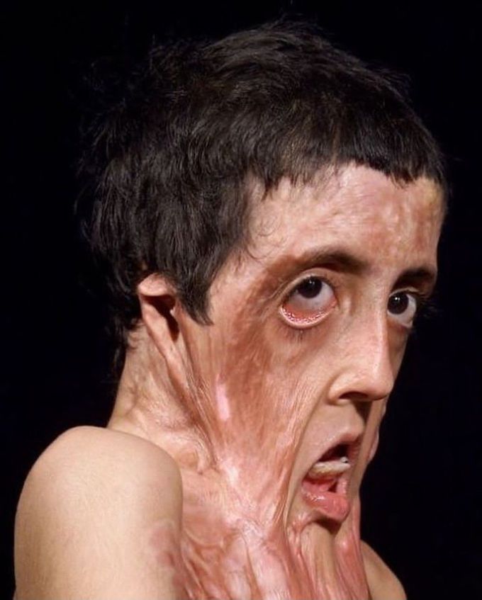 Facial Reconstruction of a Burn Victim- I