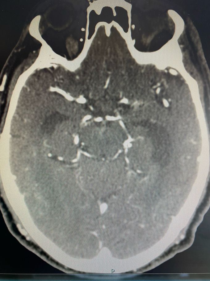 Circle of Willis on CT scan