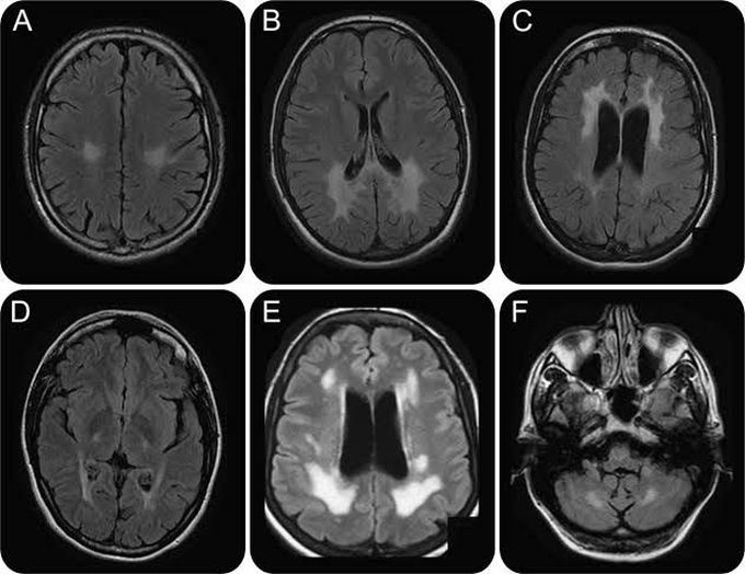 Krabbe Disease