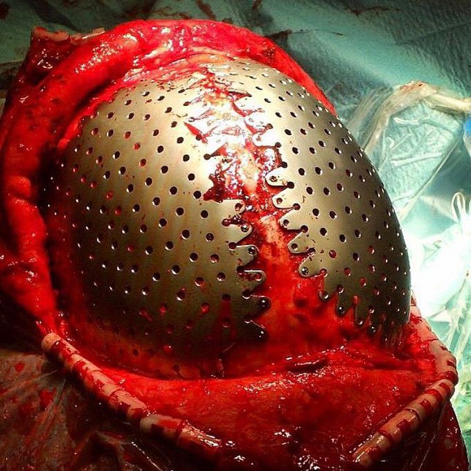 During a Neurosurgery