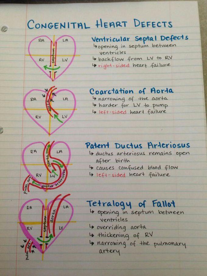 Heart defects