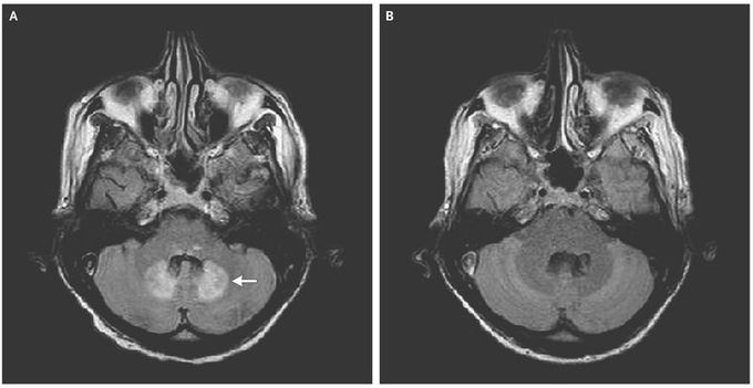 Metronidazole-Associated Encephalopathy