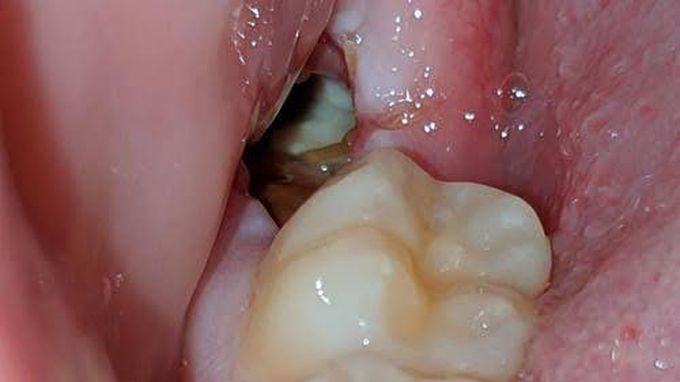 Dry socket ( alveolar osteitis)