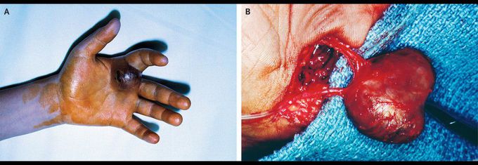 Traumatic Vascular Injury to the Hand