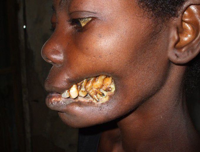 The face of poverty- Noma (Cancrum Oris)