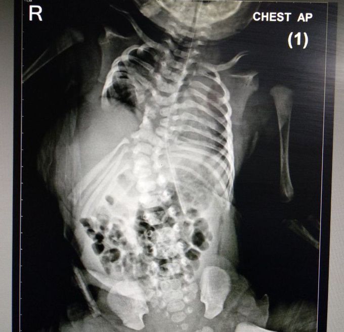 Chest a/p X-ray