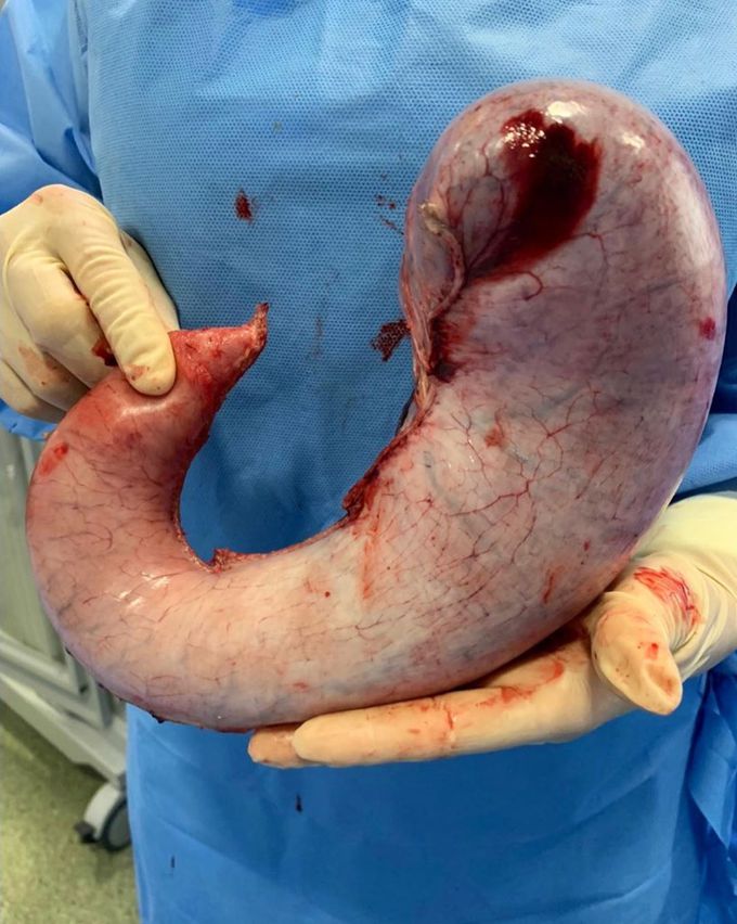 Weight loss by resecting the stomach! ⁣ 