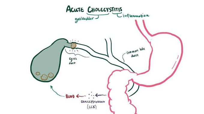 Treatment of cholecystitis