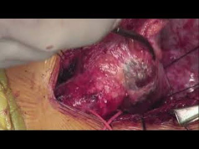 Off Pump Completion Extracardiac Fontan in Pulmonary Atresia With Intact Septum