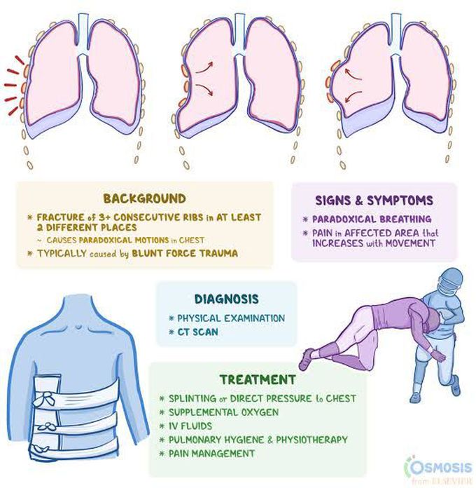 Symptoms of flail chest