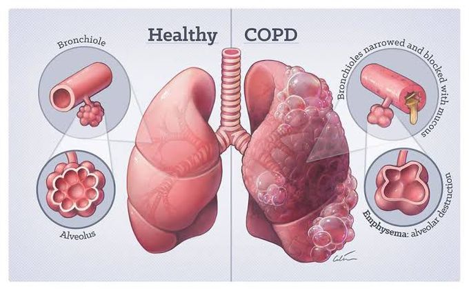 What is Chronic obstructive pulmonary disease?