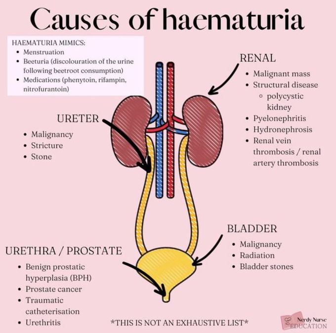 Causes of Hematuria