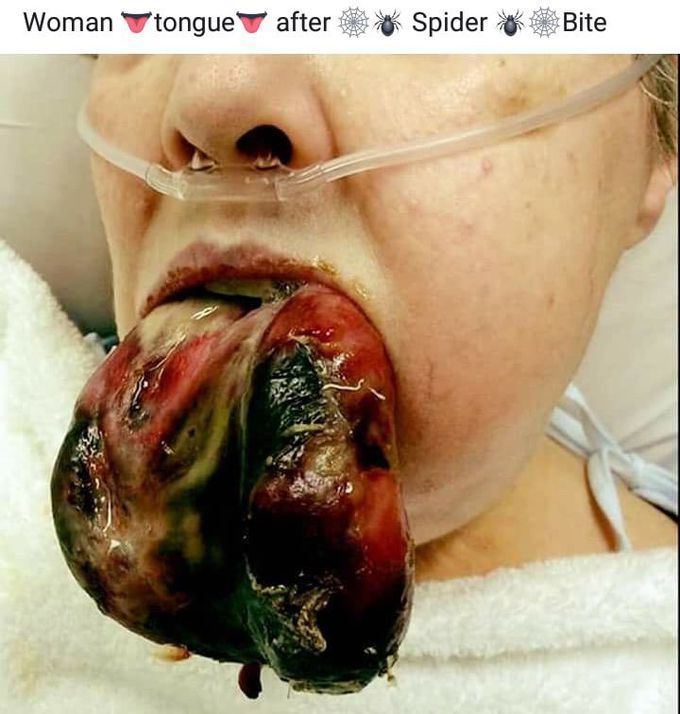 Women tongue after a spider 🕷 bite ........