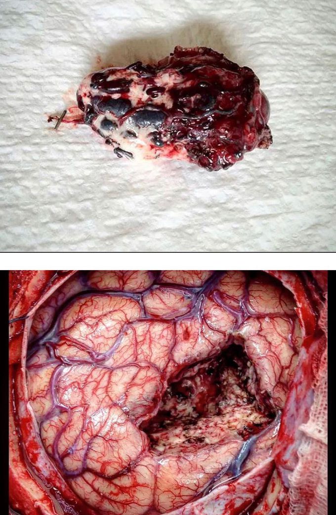 Arteriovenous malformations (AVM)