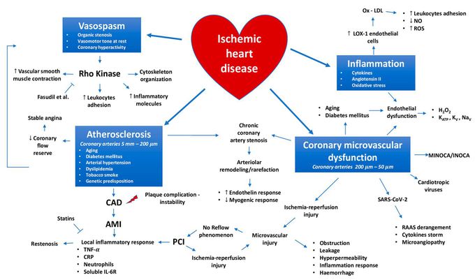 Ischemic heart disease