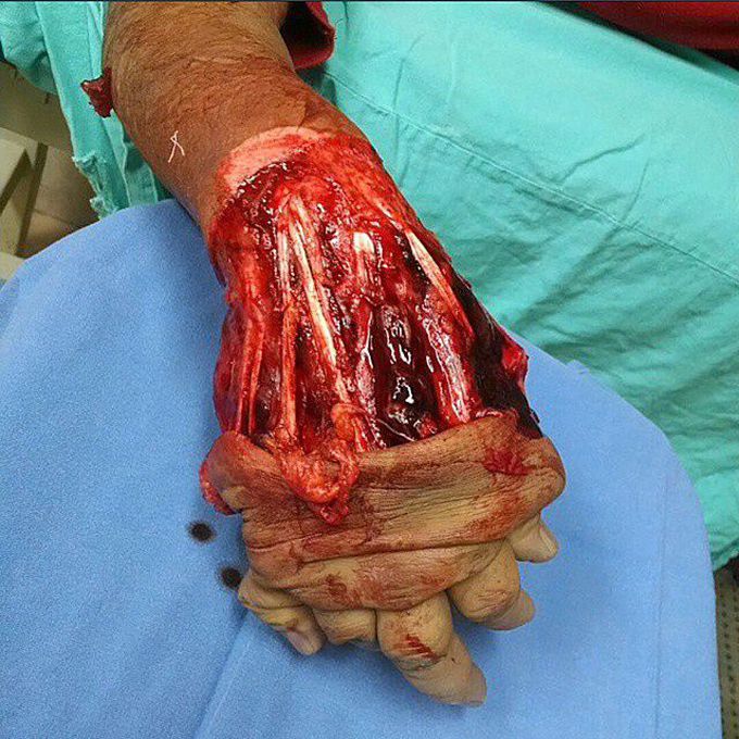 Accidents and degloving injuries are just good friends