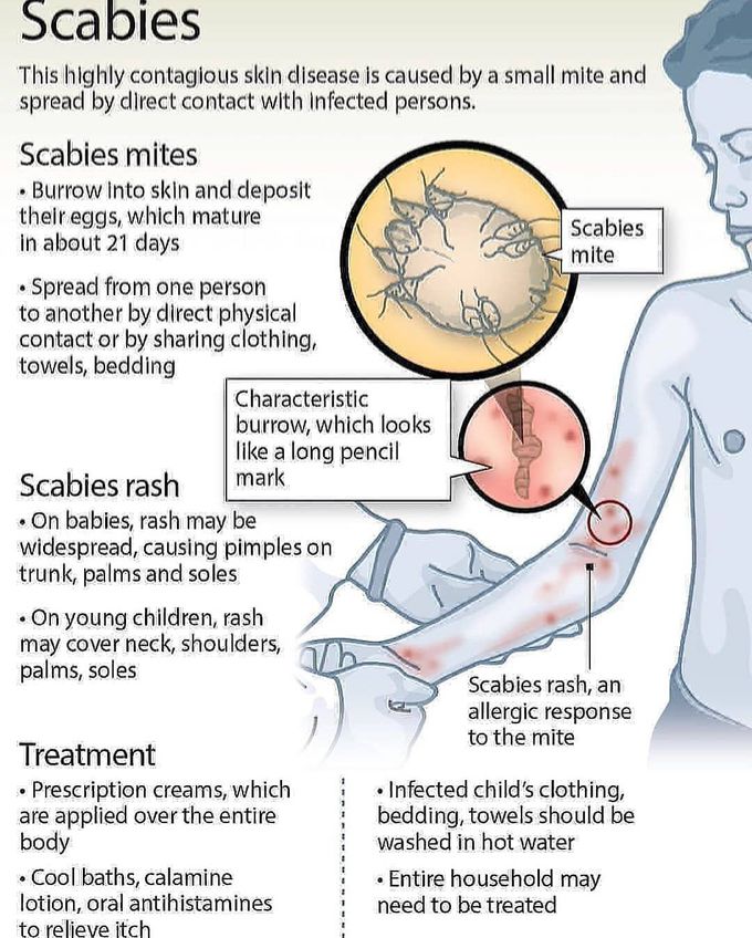 SCABIES