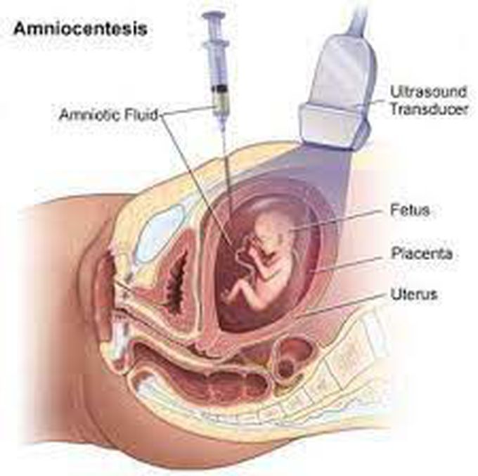 Amniocentesis