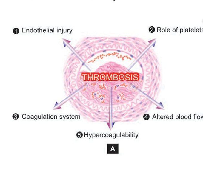 Thrombogenesis