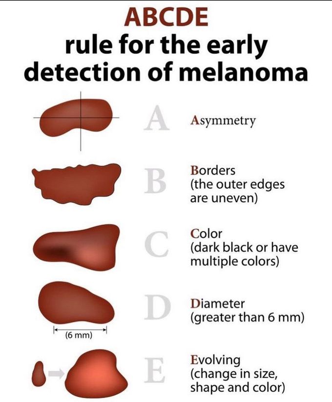 ABCDE RULE