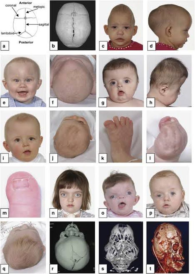 Craniosynostosis[ premature closure of sutures