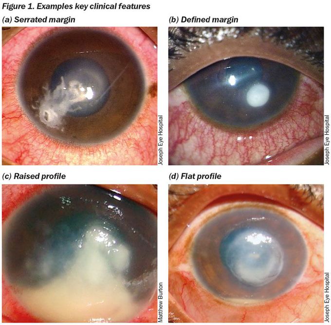 Fungal keratitis