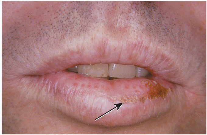 Cheilitis Glandularis