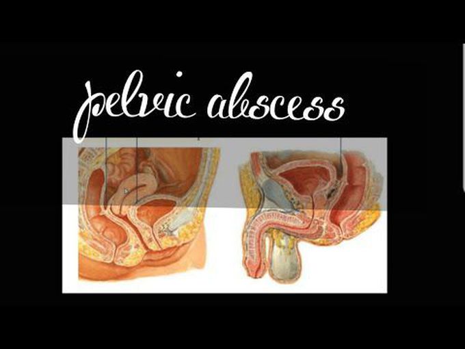 Intra-Peritoneal Abscess: Pelvic Abscess