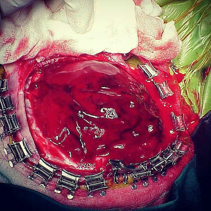 Epidural Hematoma Evacuation