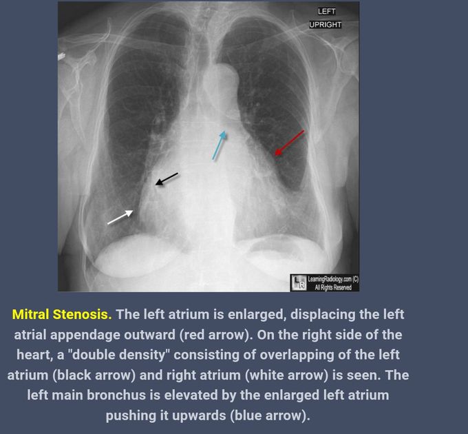 Chest x ray findings of mitral stenosis