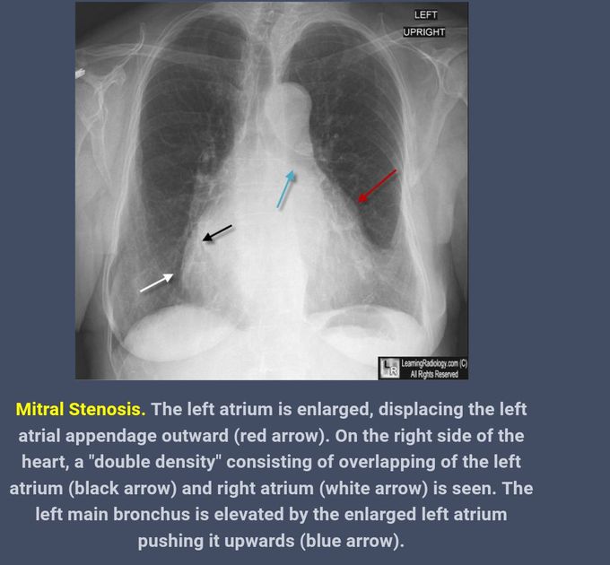 Chest X Ray Findings Of Mitral Stenosis Medizzy Sexiz Pix My Xxx Hot Girl