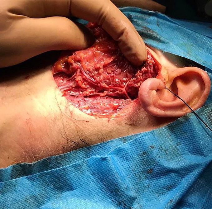 Facial nerve