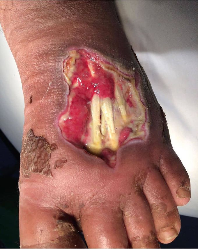 Picture shows diabetes foot ulcers