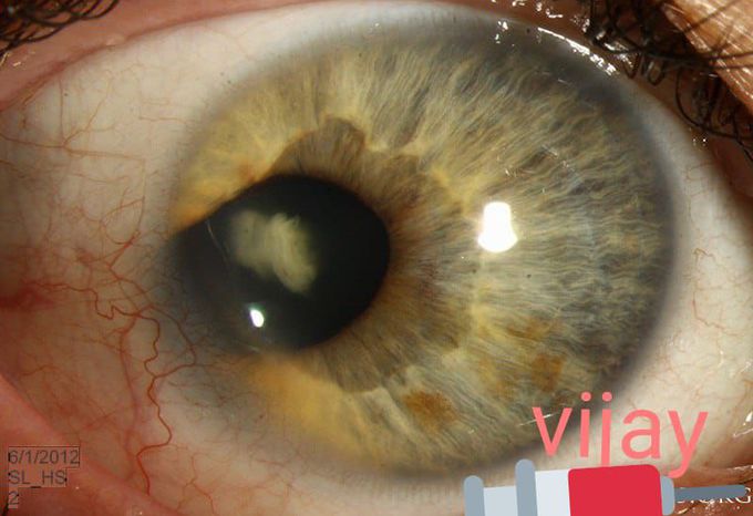 This patient presented with a temporal anterior segment coloboma in his right eye. This is unusual as colobomas are typically inferonasal, where the optic fissure fails to close completely during development.