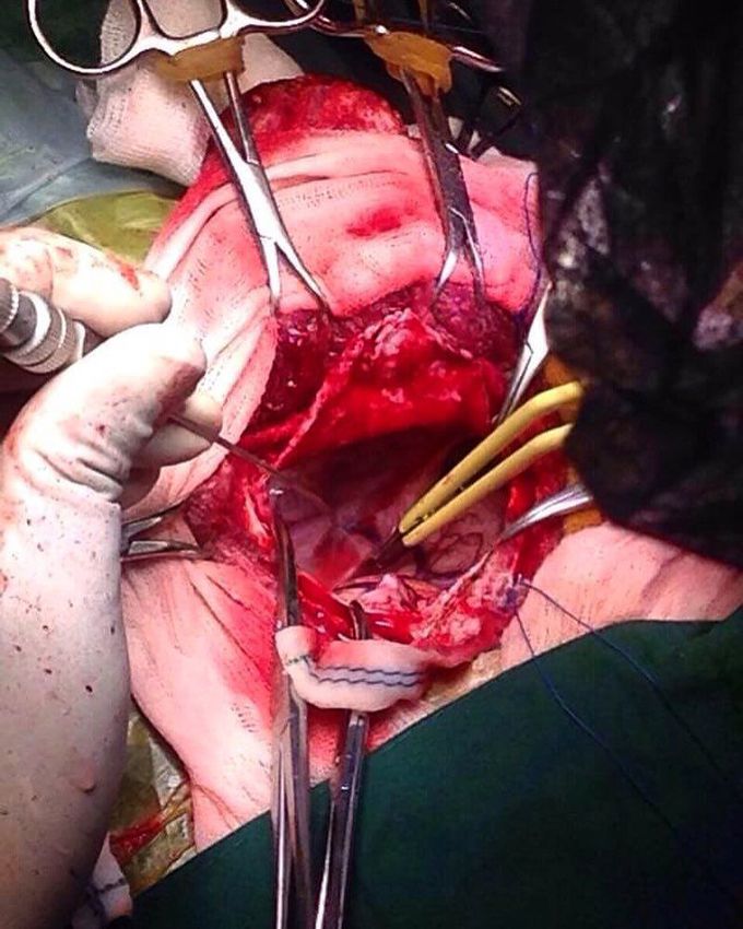 The space left after an arachnoid cyst drainage!  