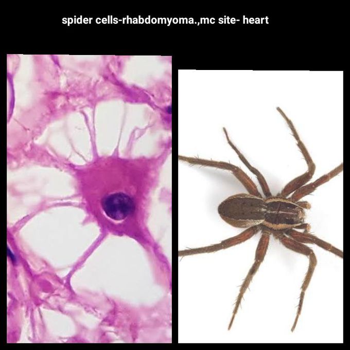 Rhabdomyoma - MEDizzy