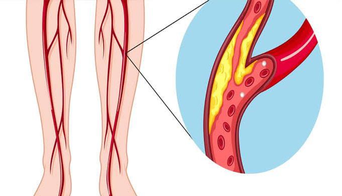 Intermittent claudication