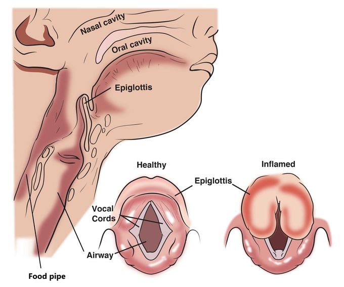 Management of epiglottitis