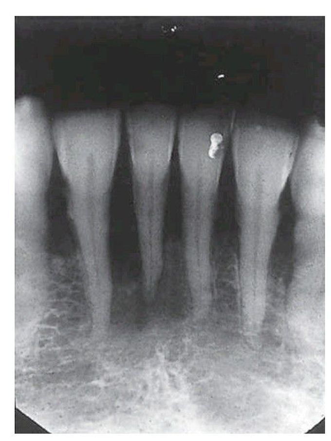 Hyperparathyroidism