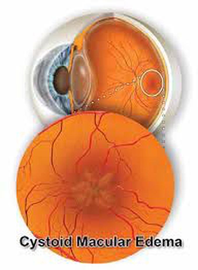 Causes of cystoid macular edema