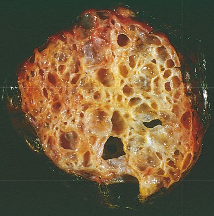 Female reproductive disorder