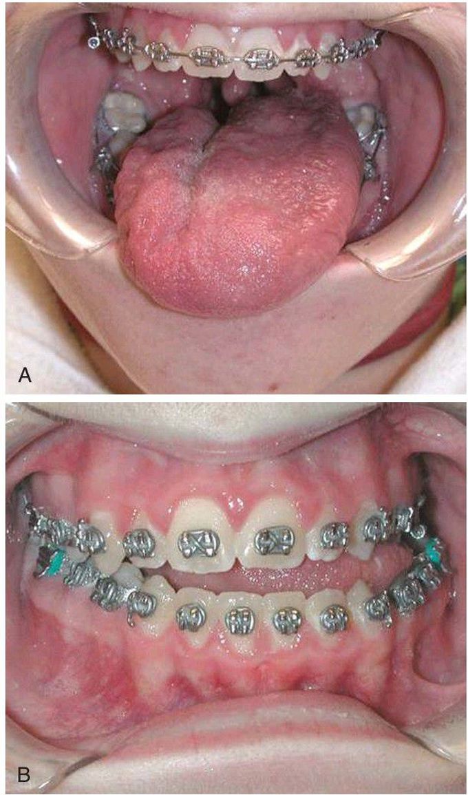 Unilateral open bite