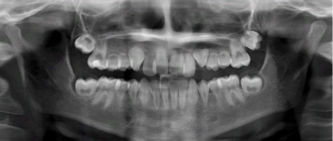 Hypoplasia caused by Antineoplastic therapy