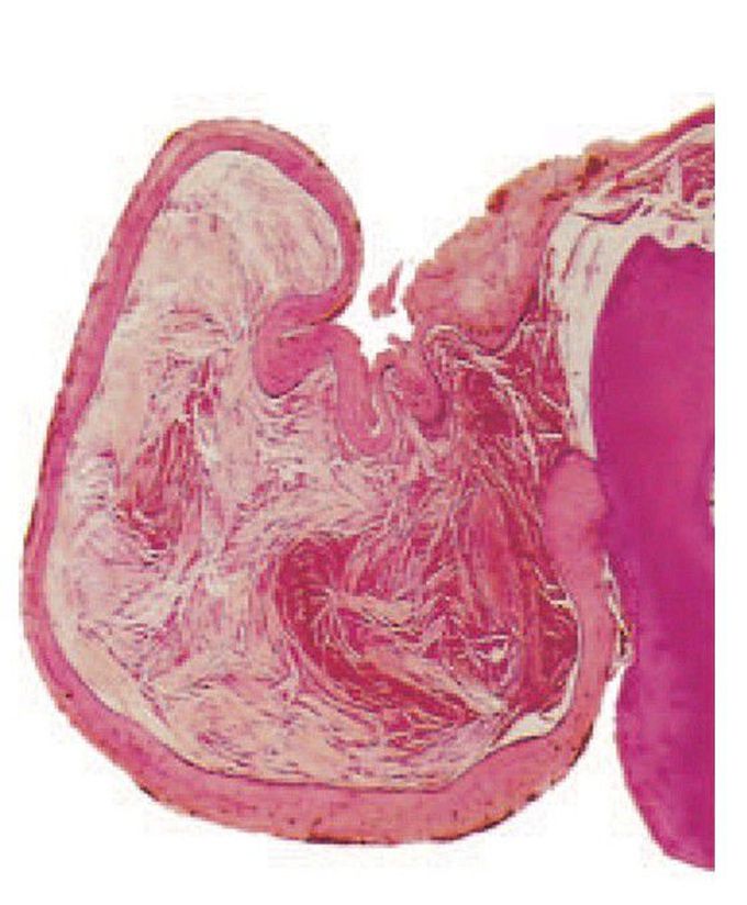 Dentigerous cyst.