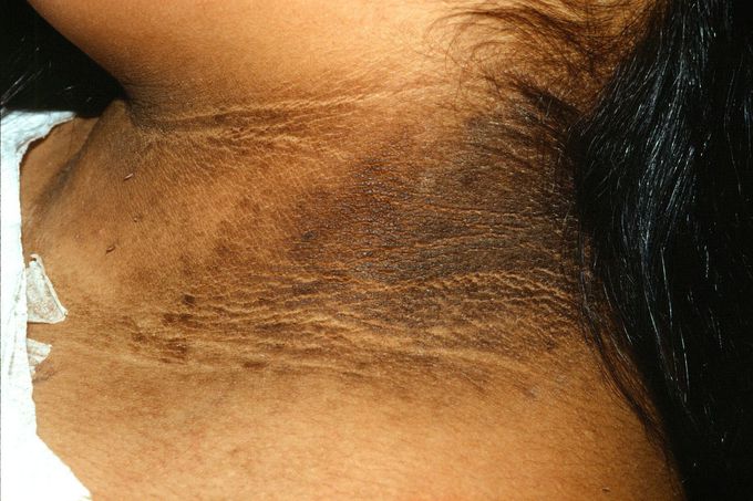 acanthosis nigricans neck