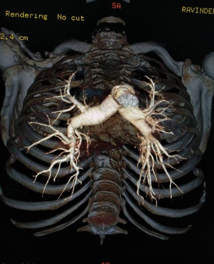 CT pulmonary angiography