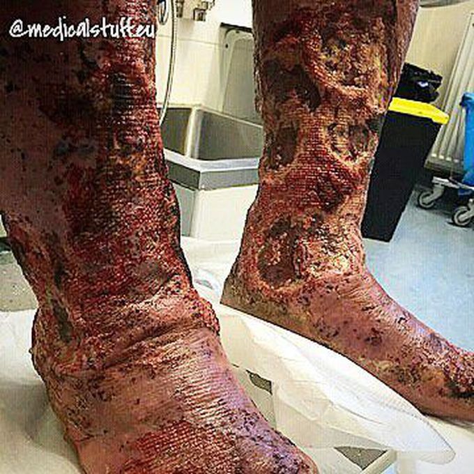 An older lady, suffering from lymphedema, ulcers and leukocytoclastic vasculitis. (The square pattern is from gauze and socks)