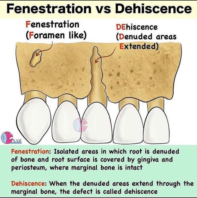 Fenestration vs dehiscence