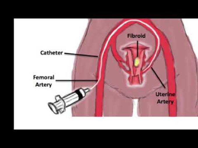 Uterine Artery Embolization